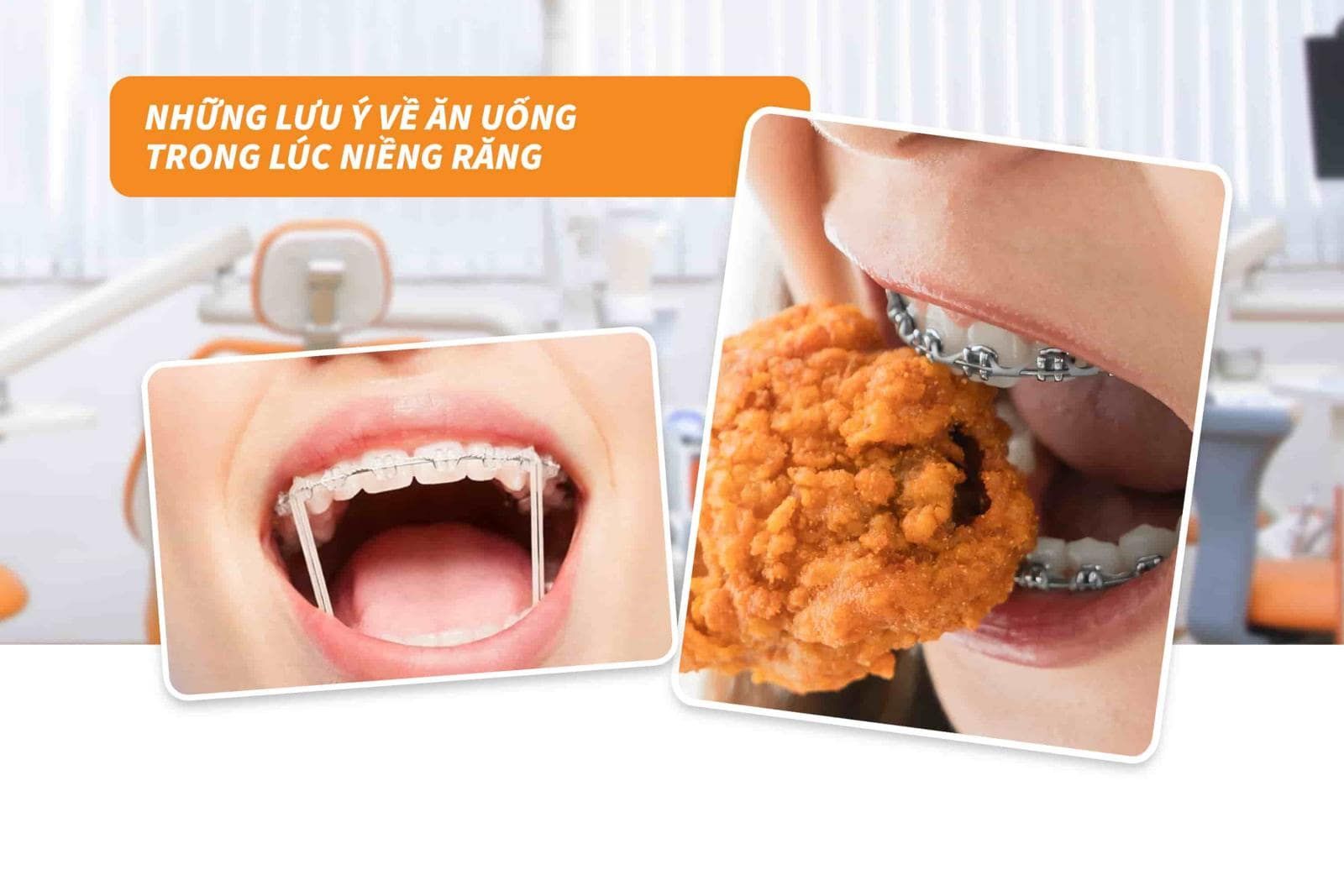 Lưu ý khi niềng răng 7: Ăn uống