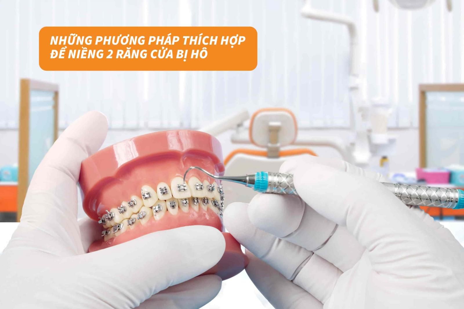 Những phương pháp thích hợp để niềng 2 răng cửa bị hô