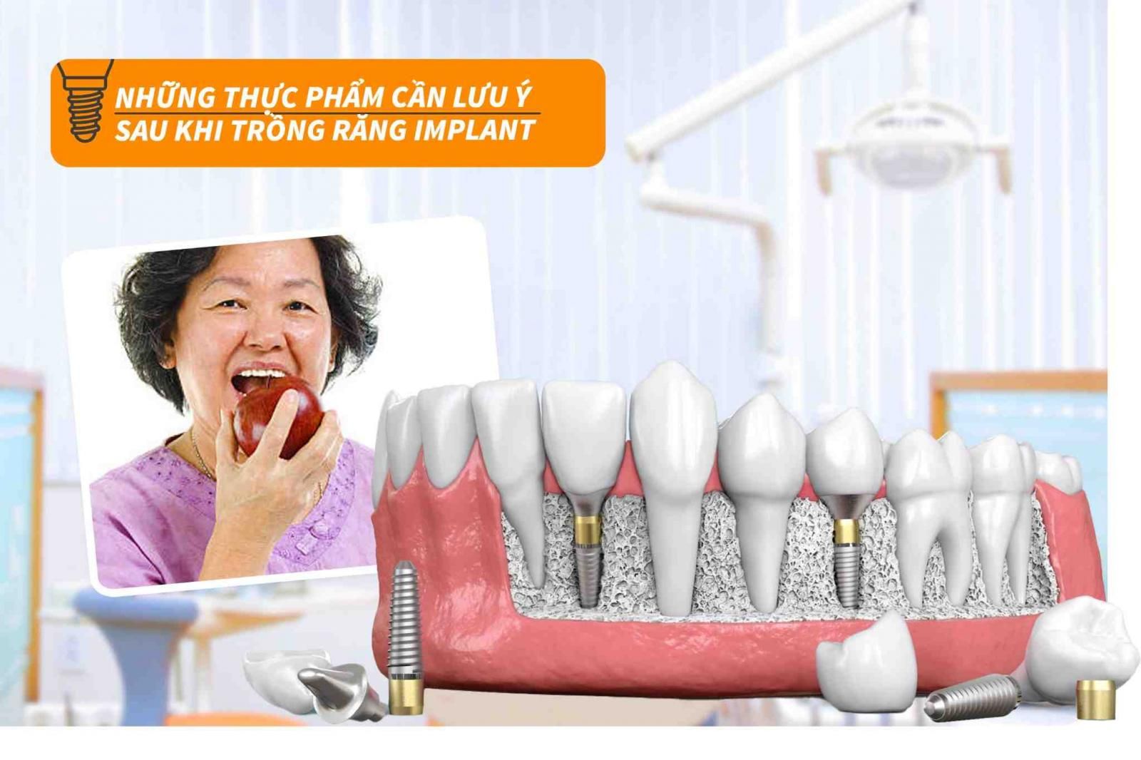 Những thực phẩm cần lưu ý sau khi trồng răng Implant