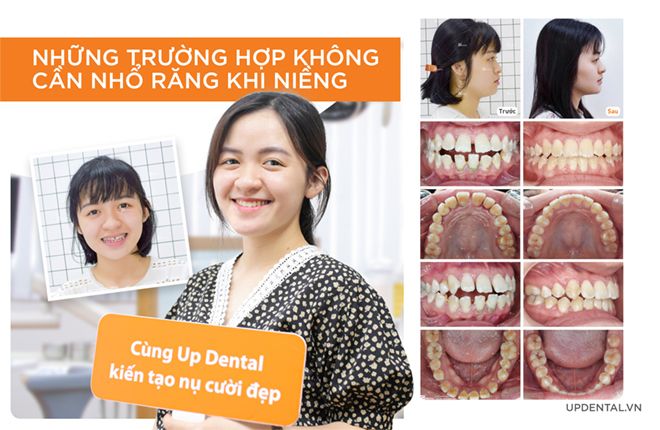 những trường hợp không nhổ răng khi niềng