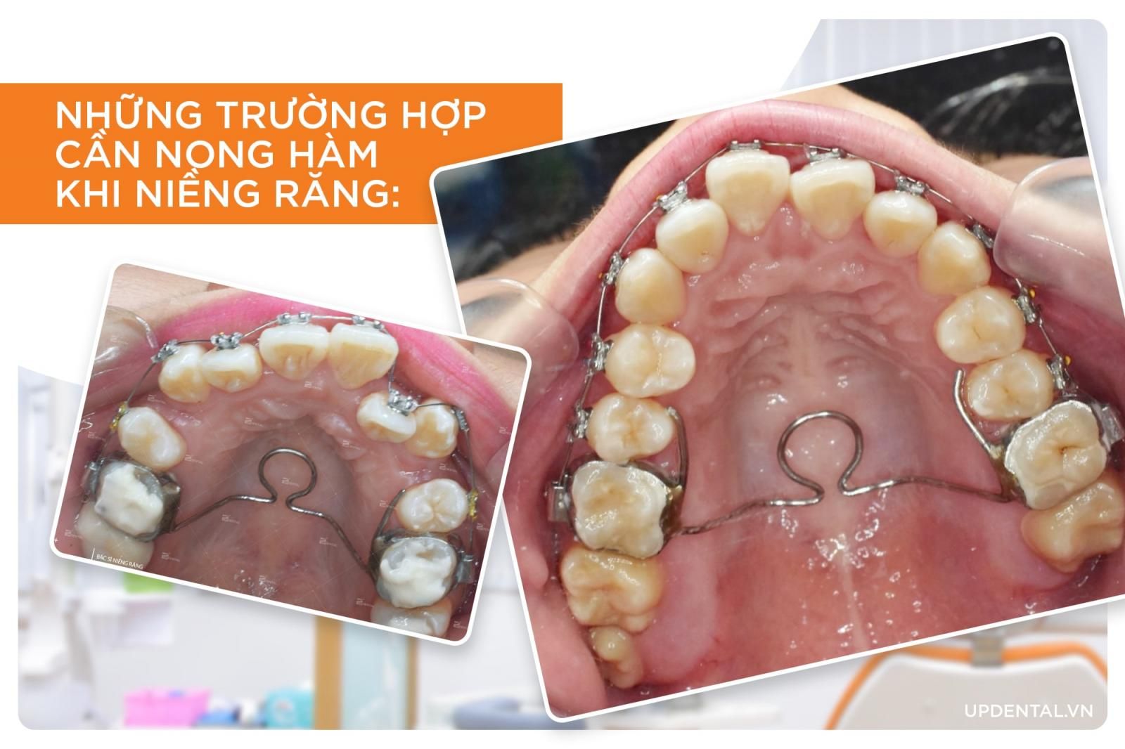 Những trường hợp cần nong hàm khi niềng răng