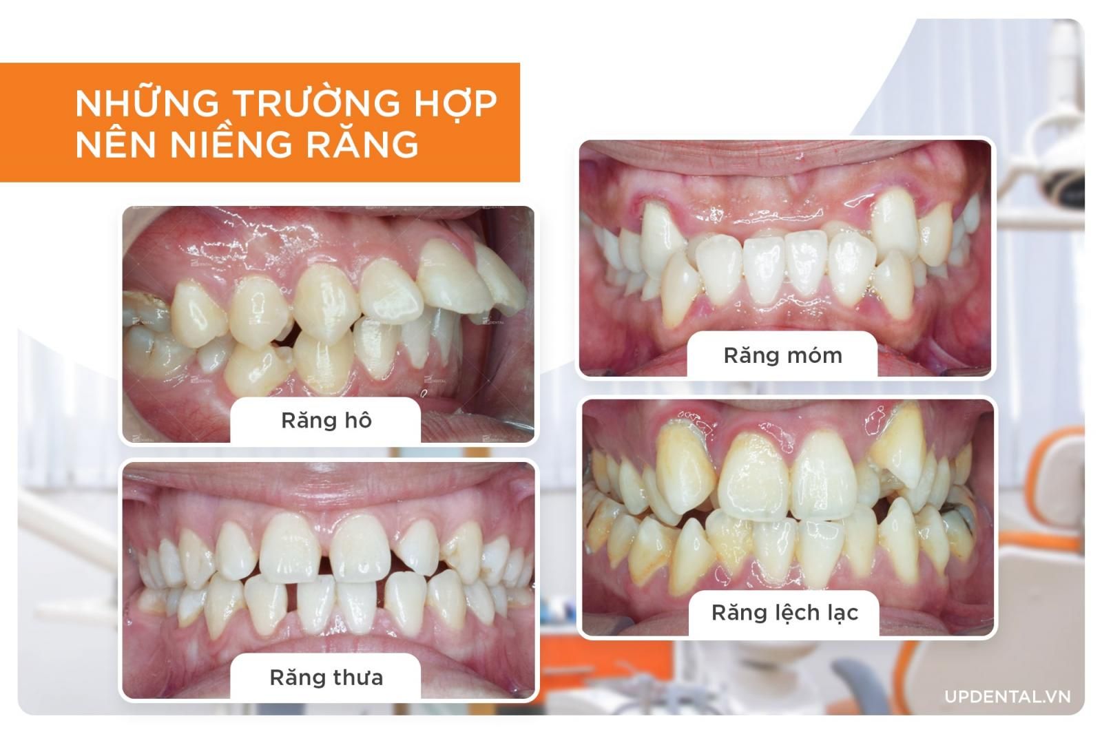 những trường hợp cần niềng răng