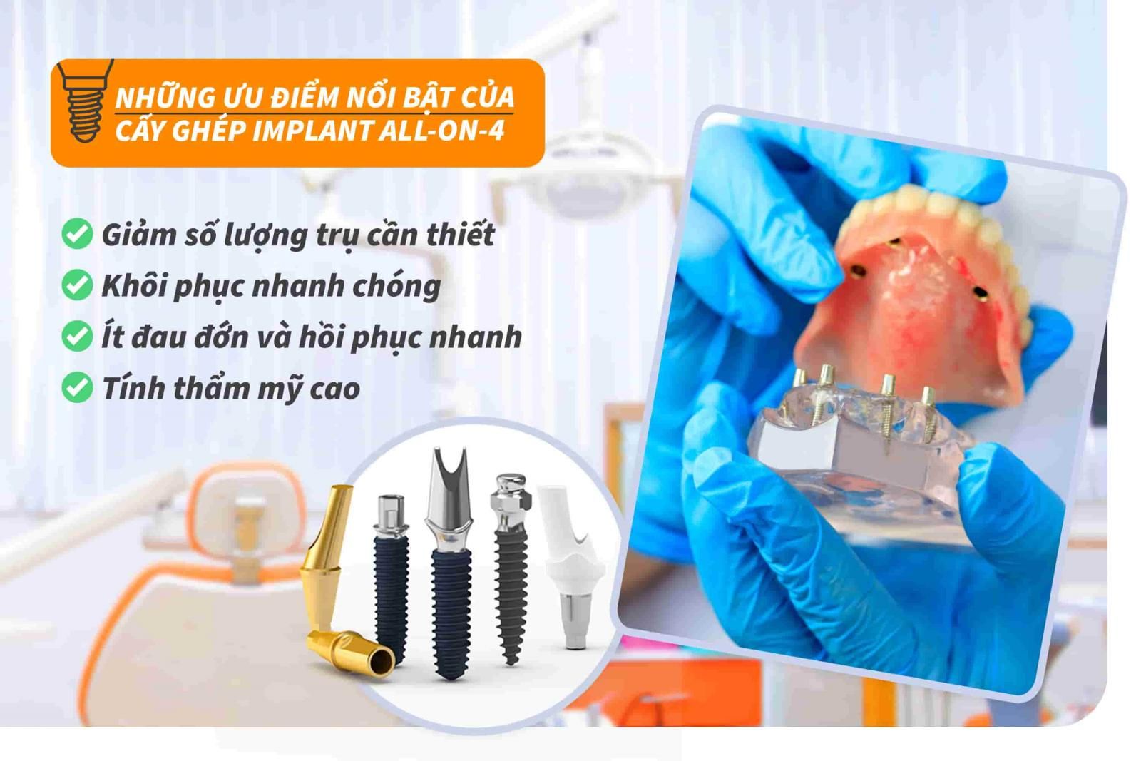 Những ưu điểm nổi bật của cấy ghép Implant All-on-4