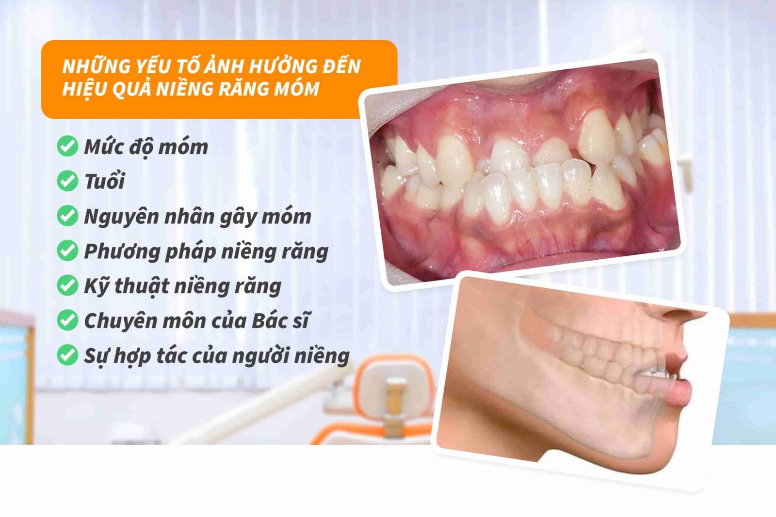 Những yếu tố ảnh hưởng đến hiệu quả niềng răng móm