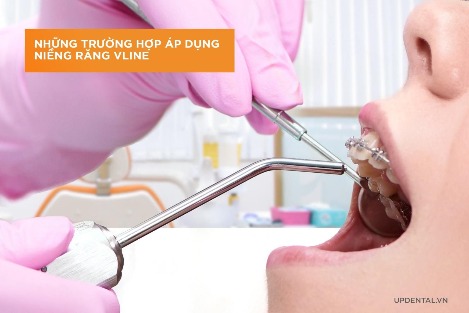 Những trường hợp niềng răng Vline