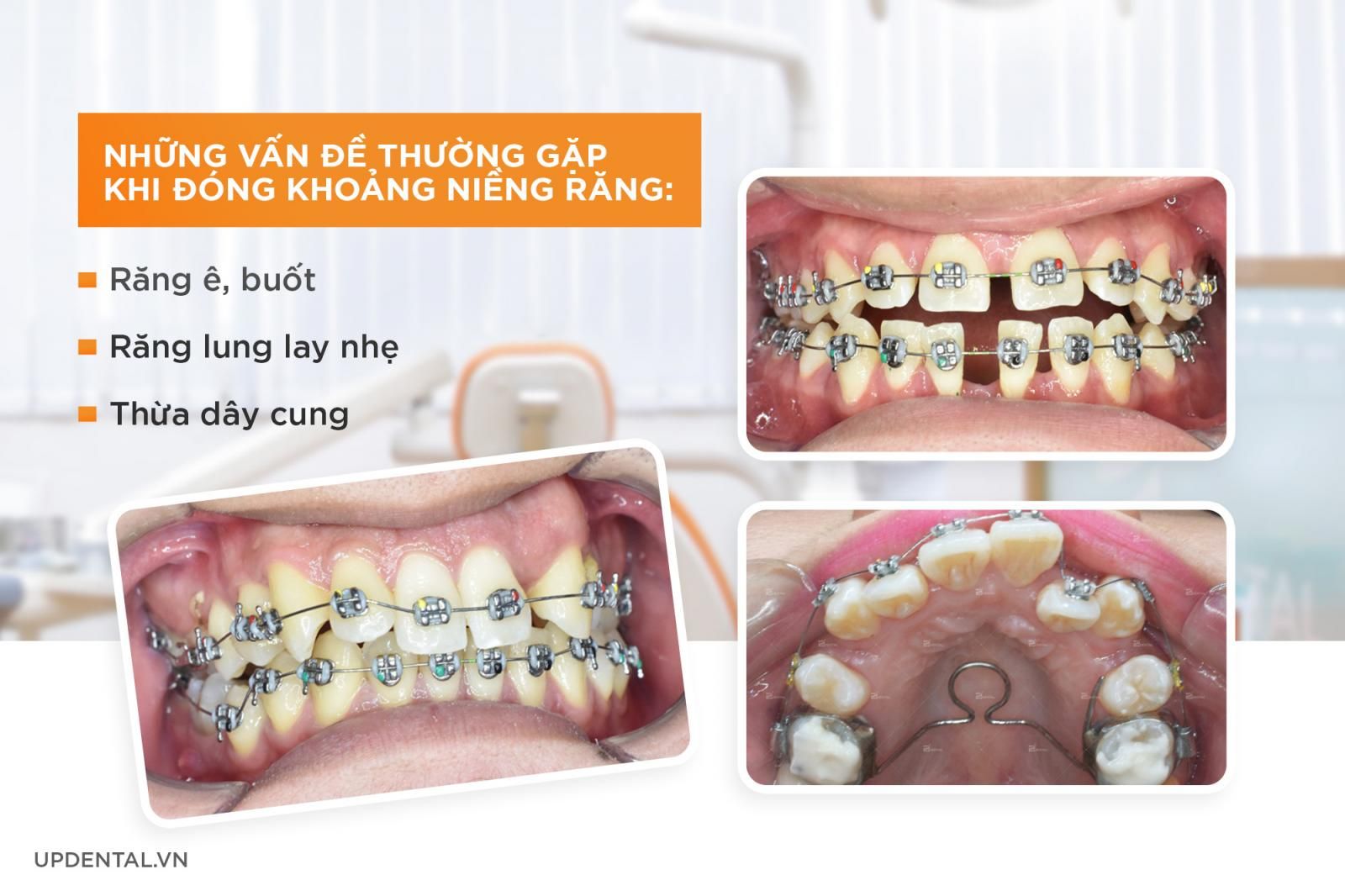 Những vấn đề thường gặp khi đóng khoảng