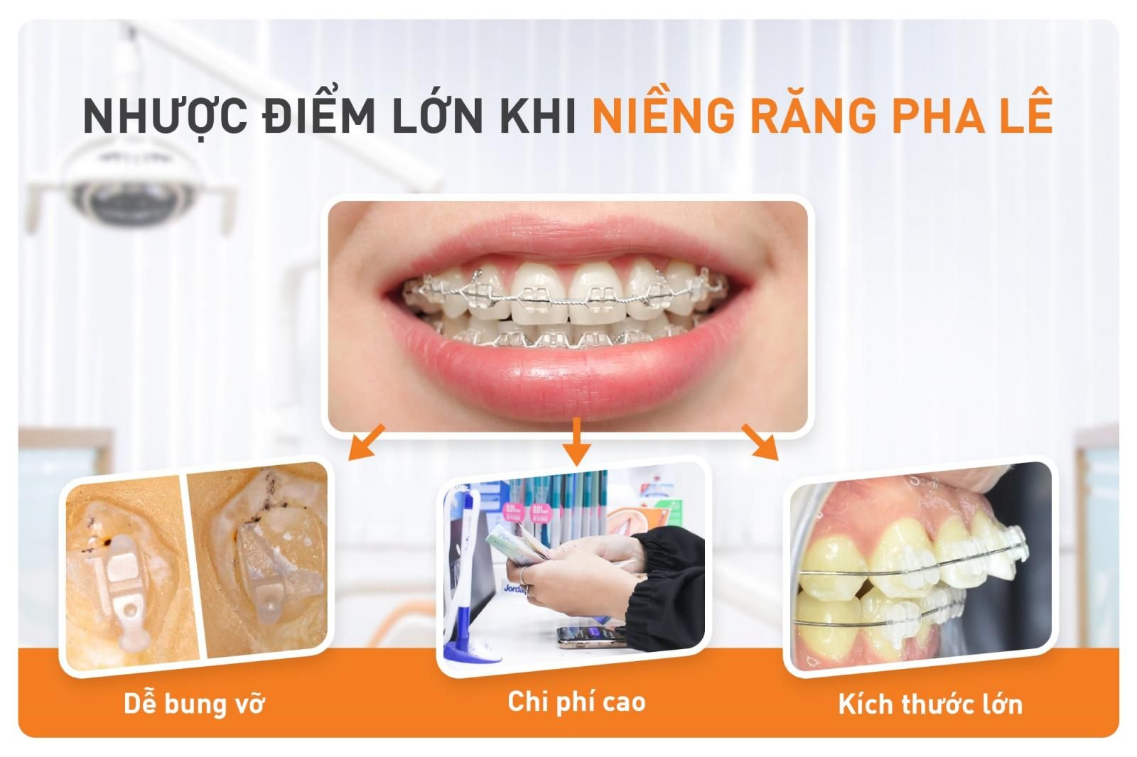 nhược điểm niềng răng pha lê