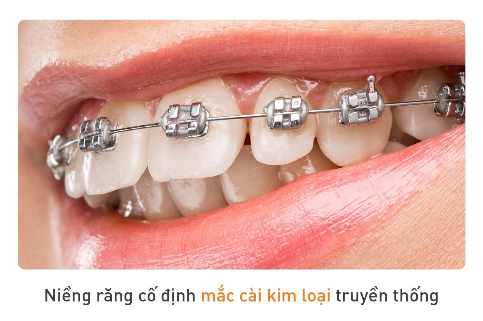 niềng răng cố định truyền thống