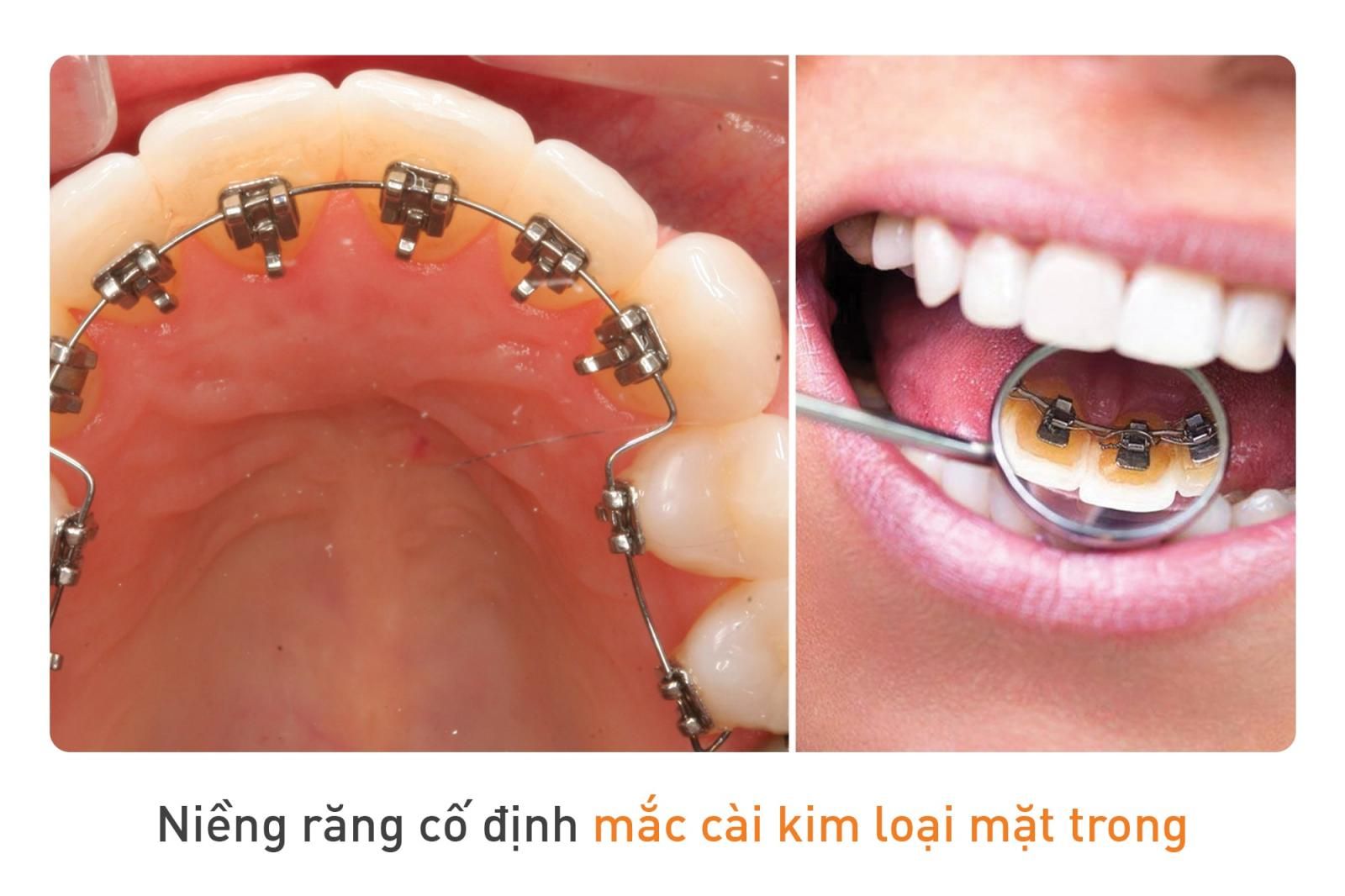 niềng răng mặt trong