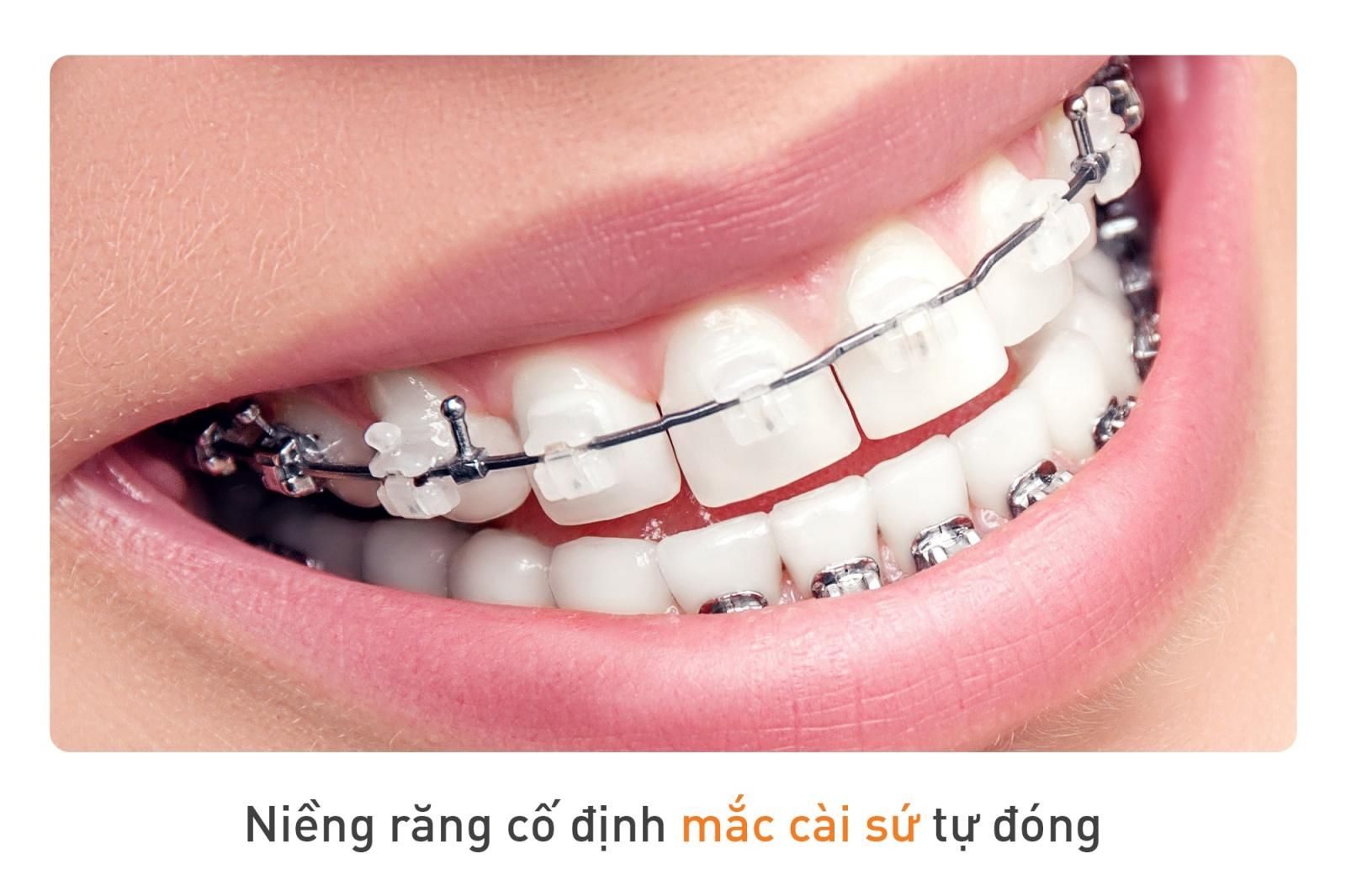 niềng răng cố định sứ tự buộc