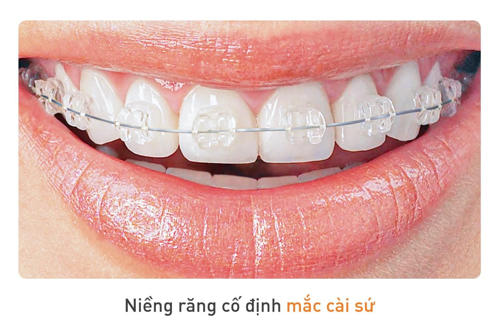 niềng răng cố định sứ tự buộc