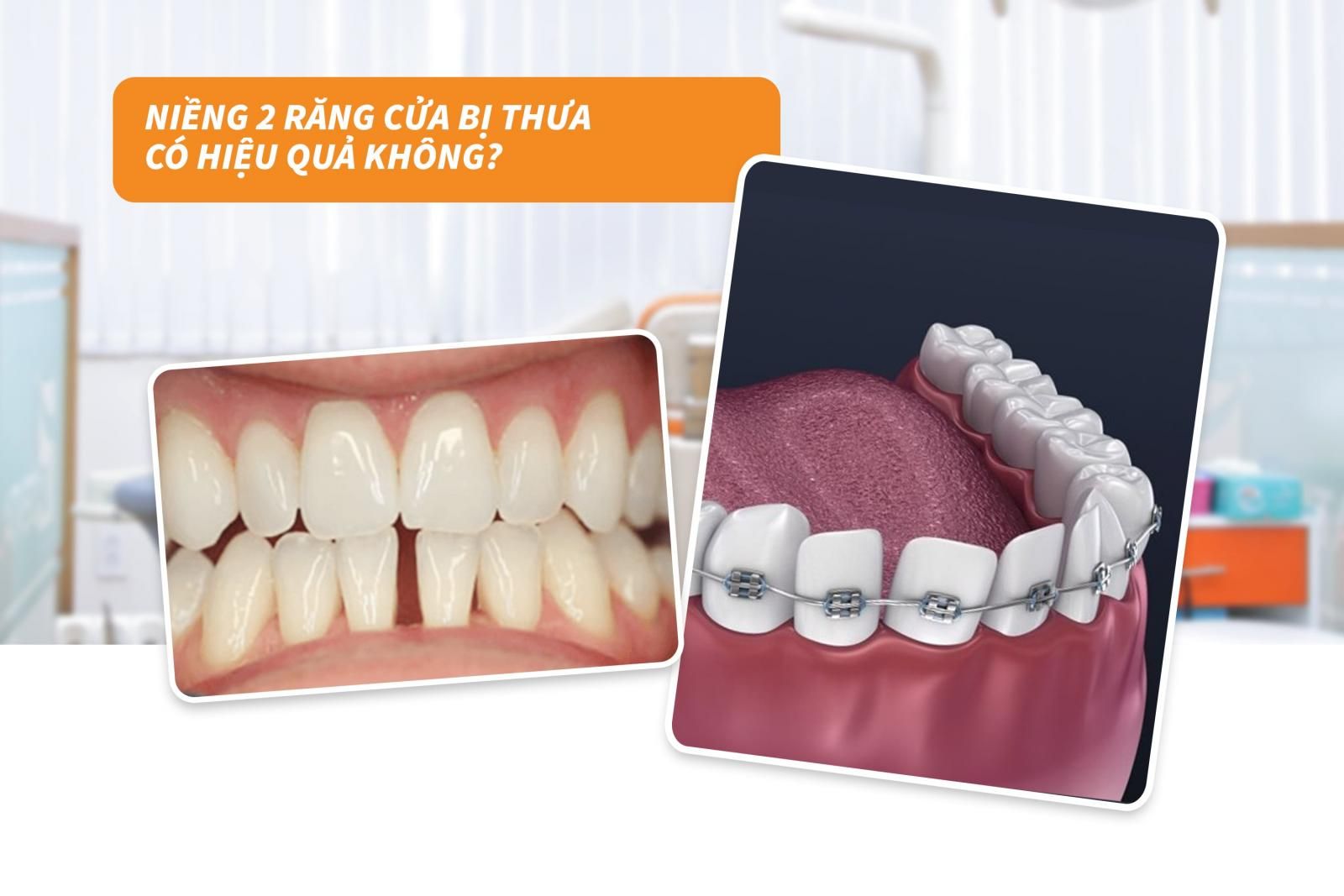 Niềng 2 răng cửa bị thưa có hiệu quả không? 