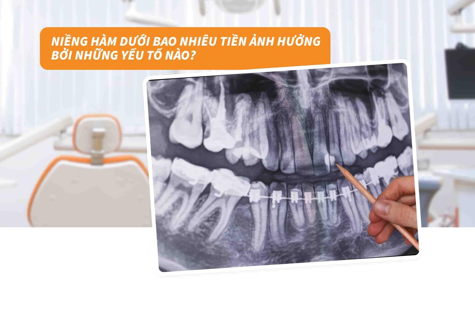 Niềng hàm dưới bao nhiêu tiền ảnh hưởng bởi những yếu tố nào?