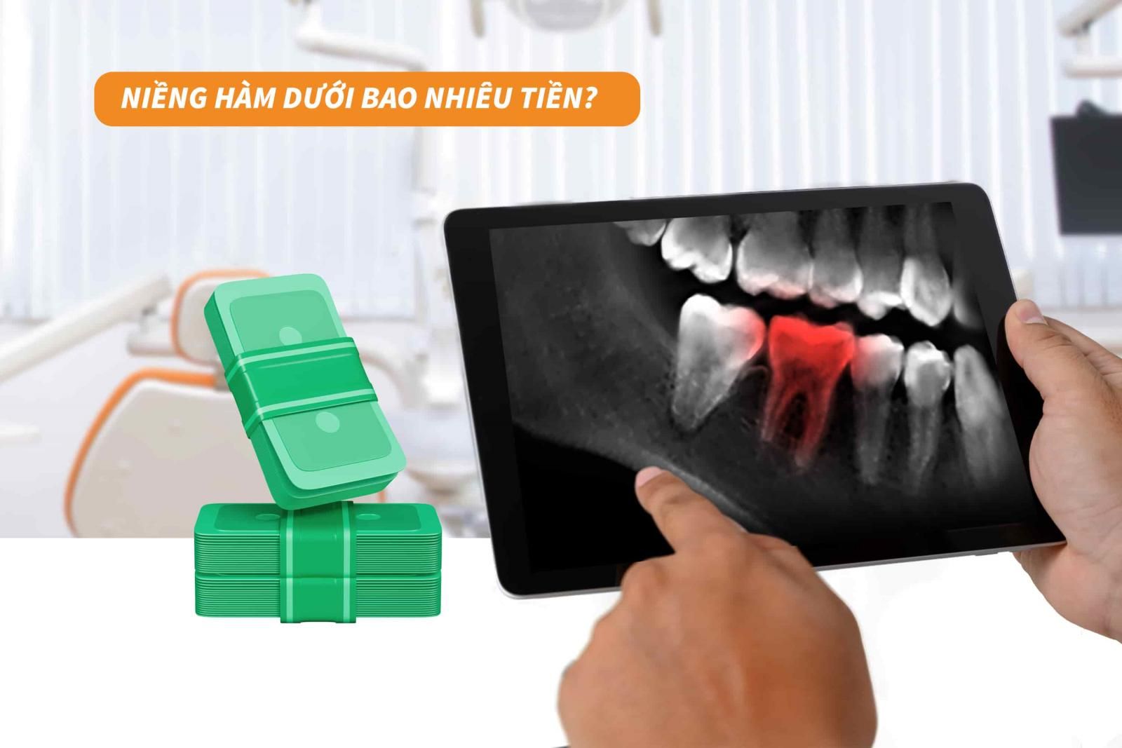 Niềng hàm dưới bao nhiêu tiền?