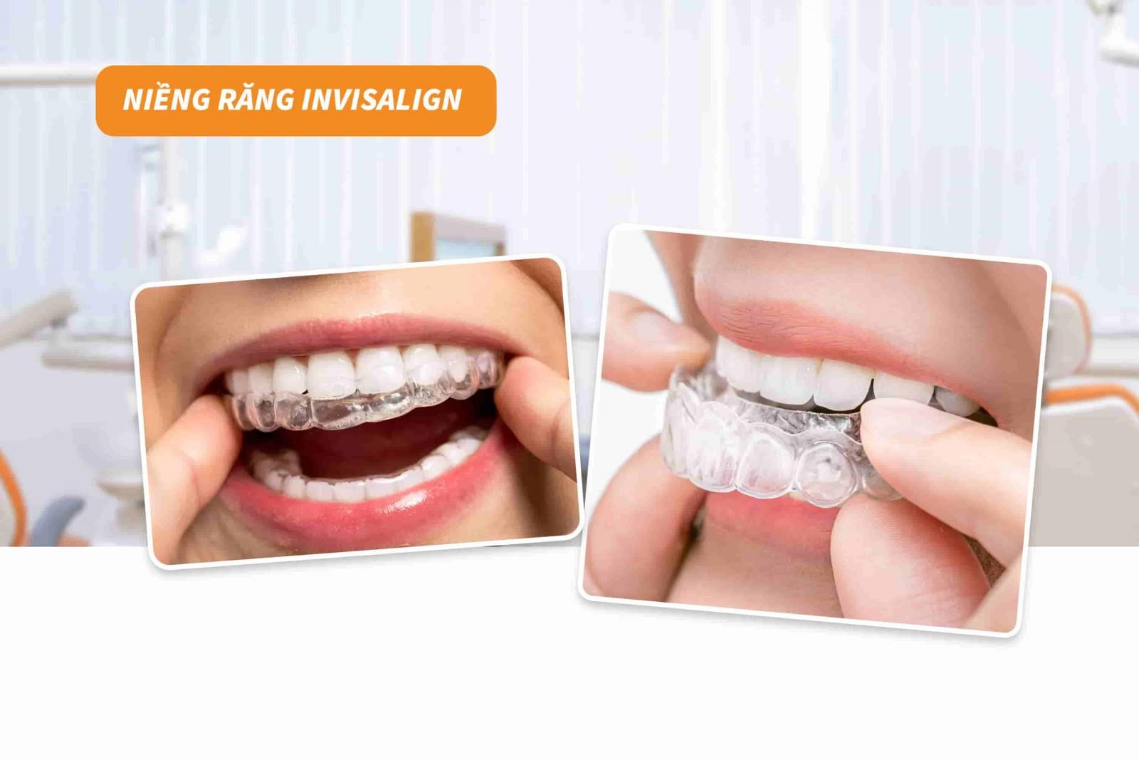 Niềng răng Invisalign