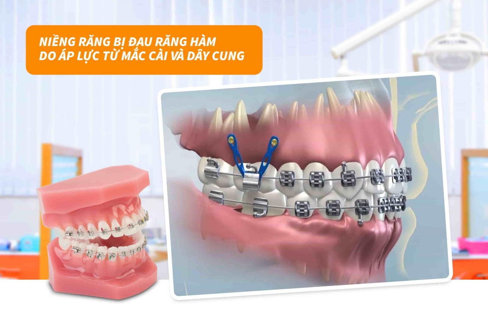 Áp lực từ mắc cài và dây cung 