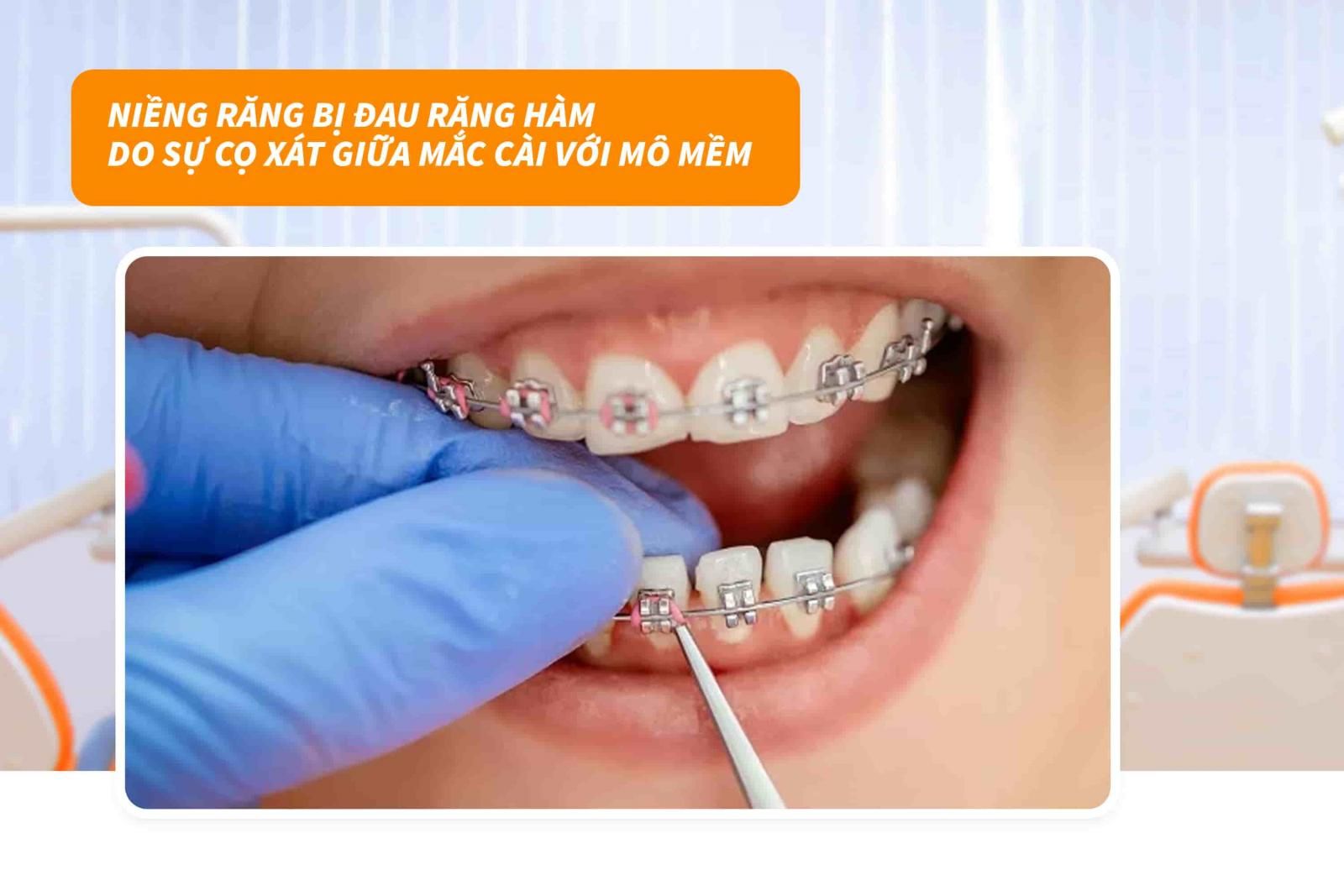 Sự cọ xát giữa mắc cài với mô mềm 