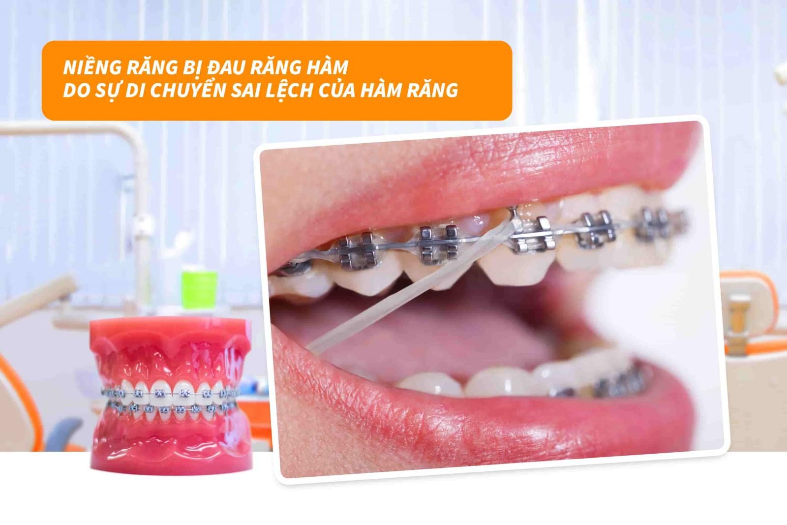 Sự di chuyển sai lệch của hàm răng