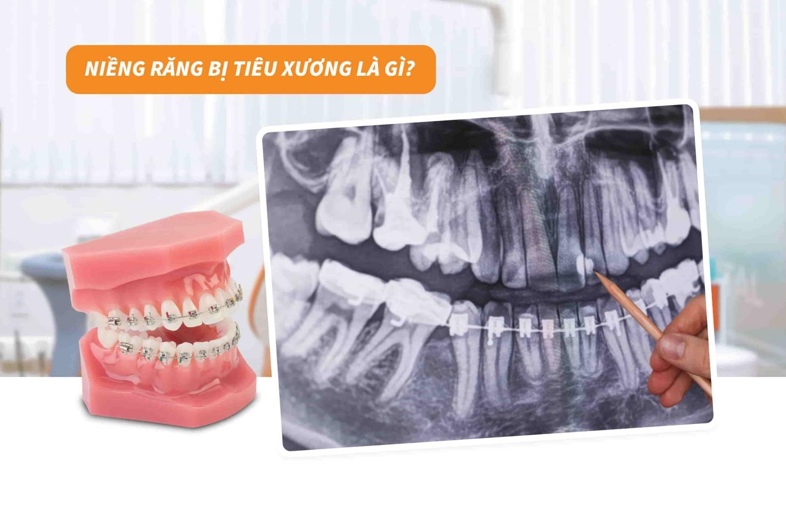 Niềng răng bị tiêu xương là gì? 