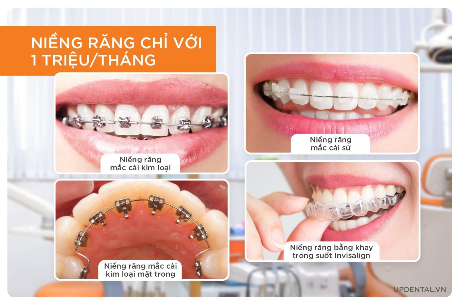 niềng răng chỉ 1 triệu/tháng