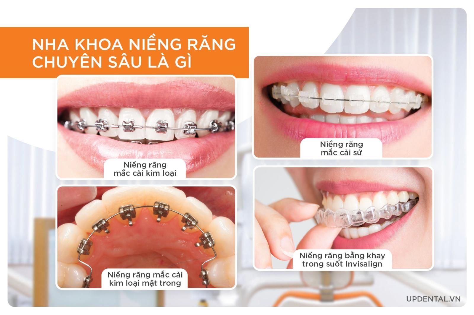 nha khoa niềng răng chuyên sâu là gì