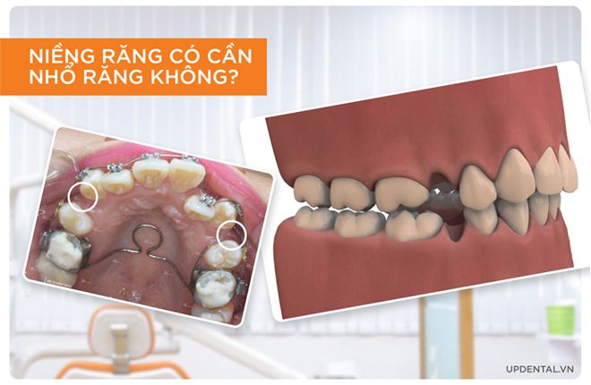 niềng răng có cần nhổ răng không?