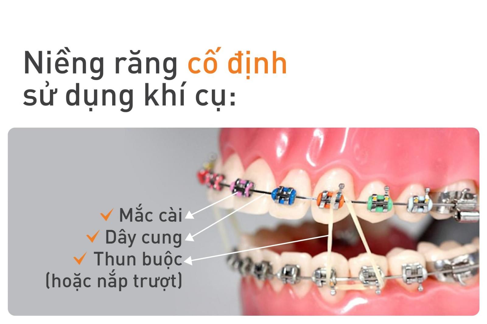 niềng răng cố định là gì