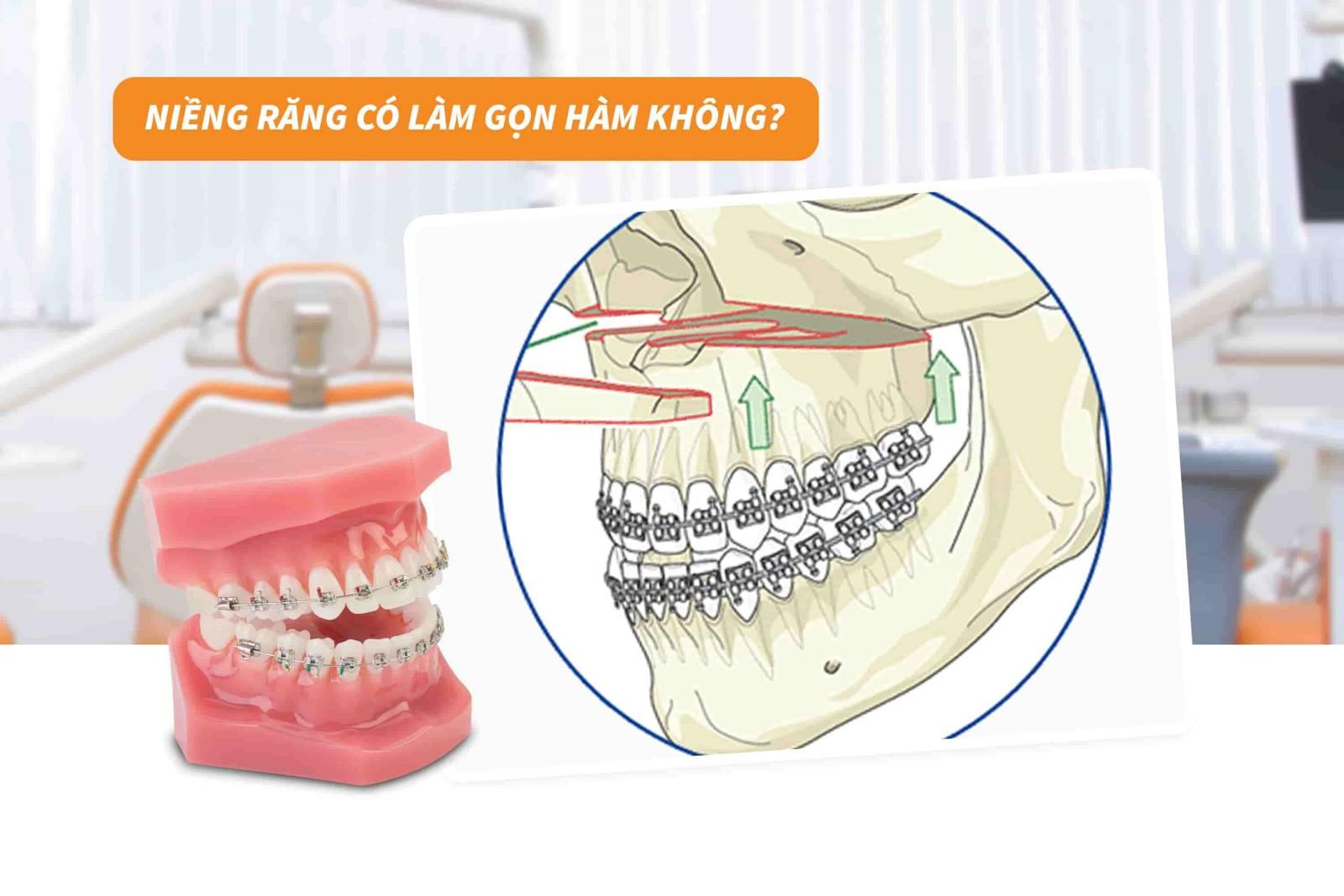 Niềng răng có làm gọn hàm không?