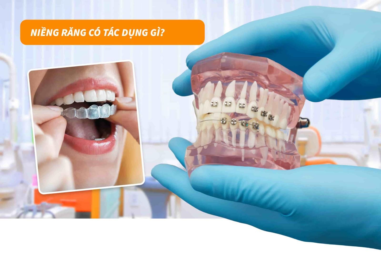 Niềng răng có tác dụng gì