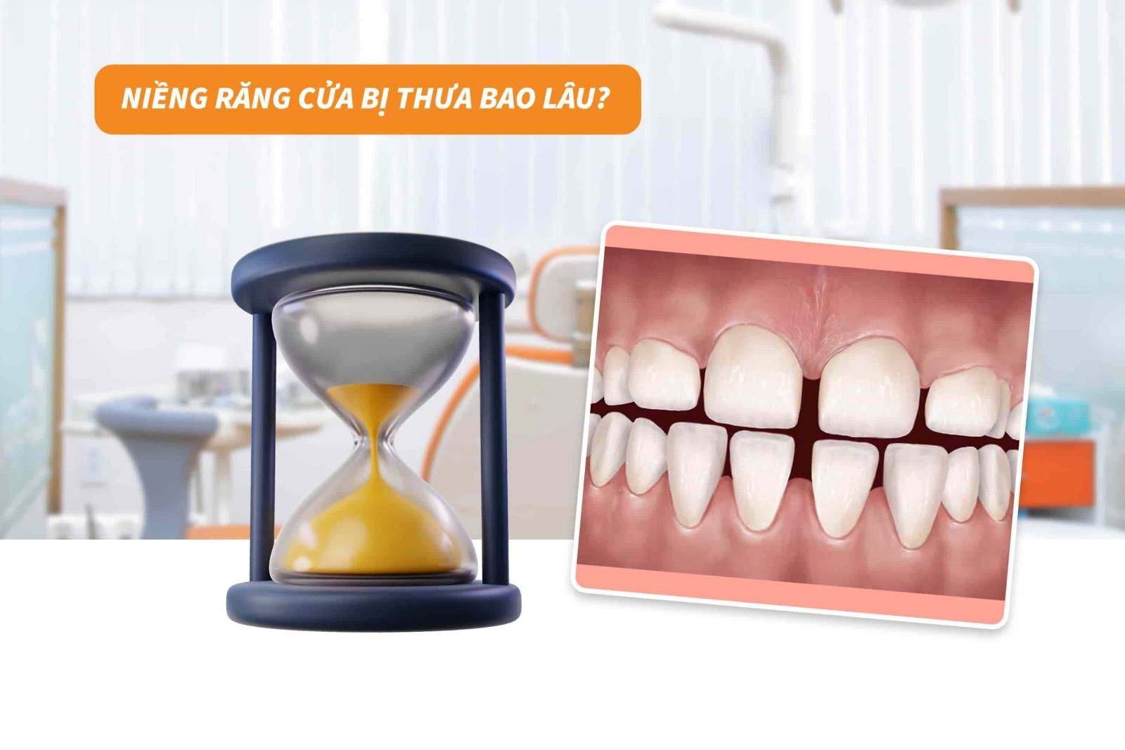 Niềng răng cửa bị thưa bao lâu? 