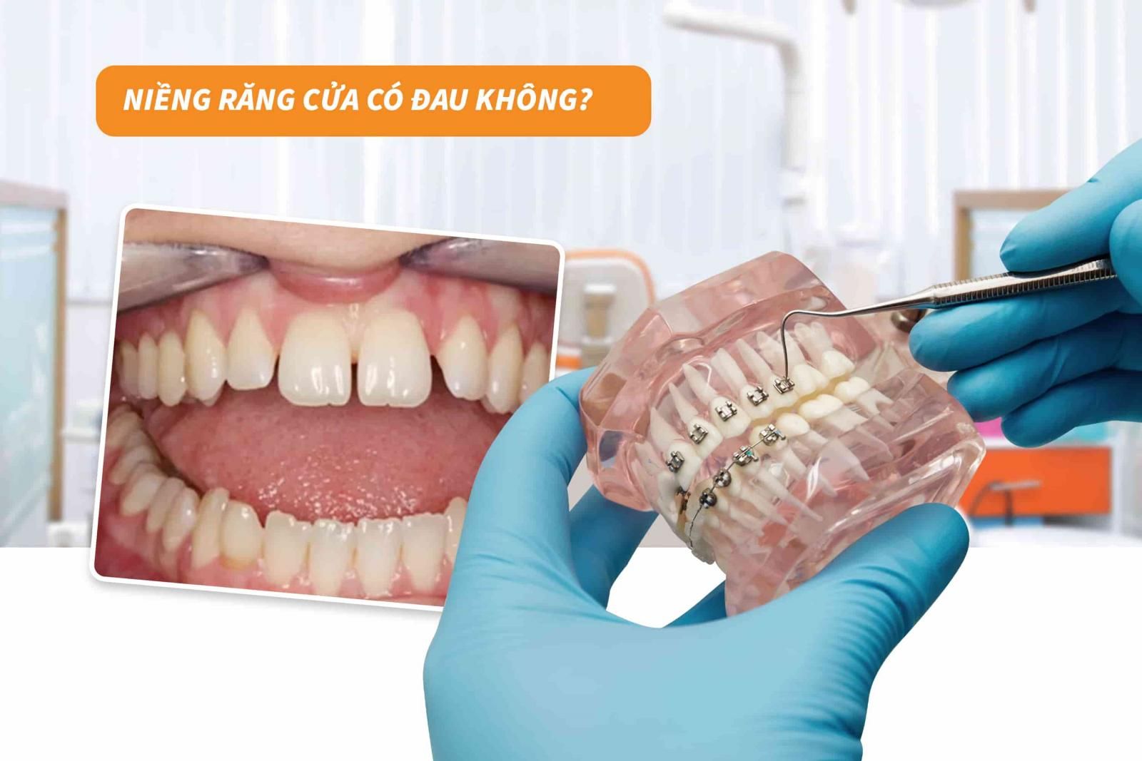 Niềng răng cửa có đau không?