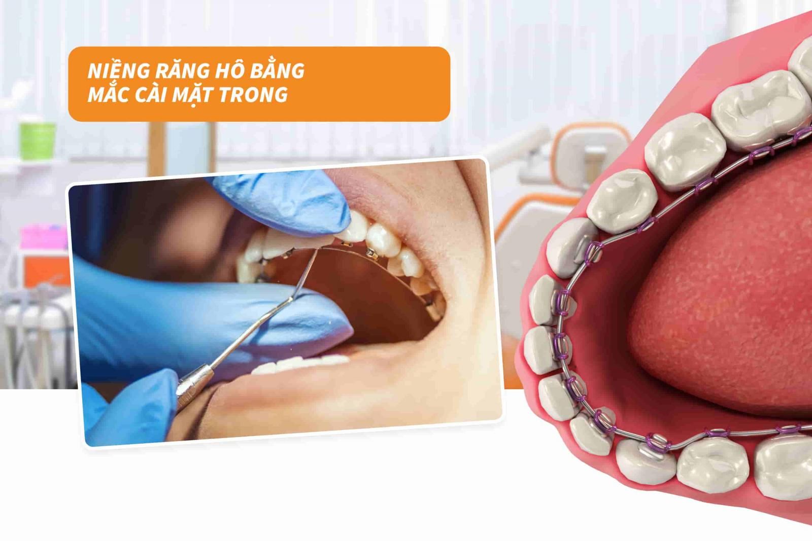 Niềng răng hô bằng mắc cài mặt trong