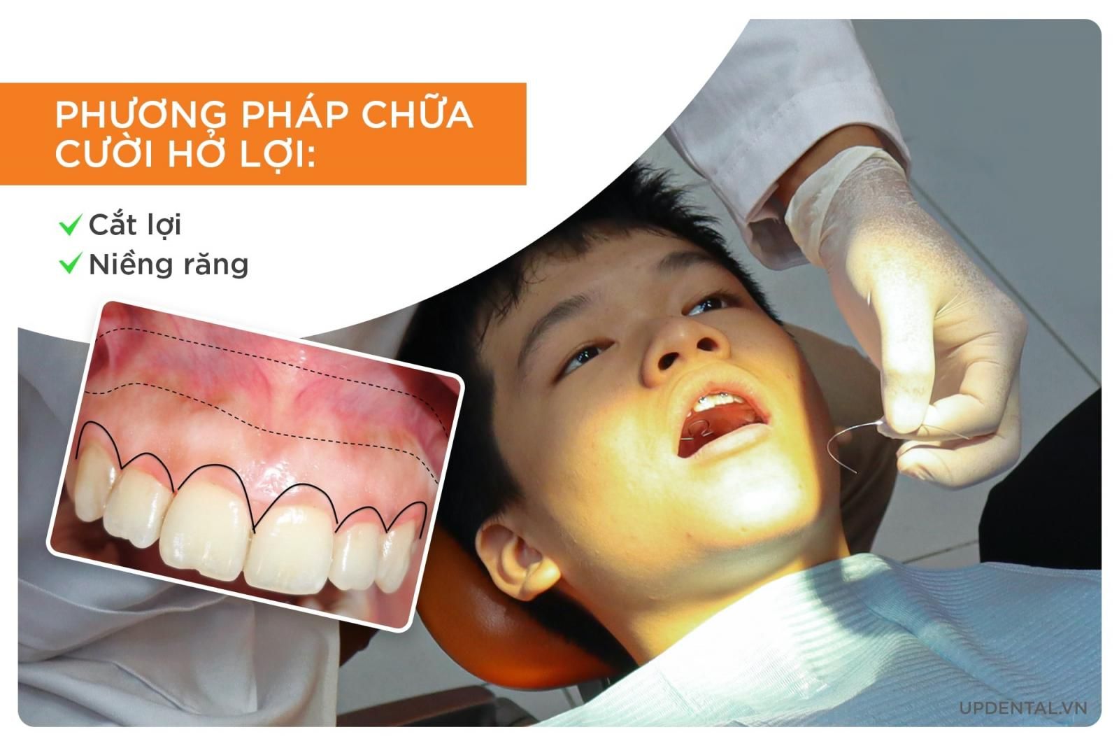 phương pháp chữa cười hở lợi