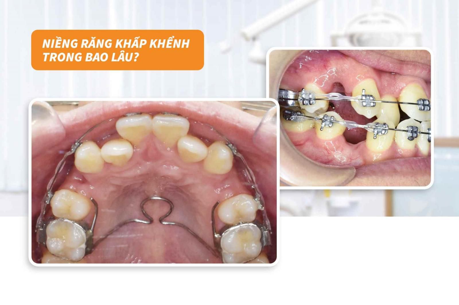 Niềng răng khấp khểnh trong bao lâu