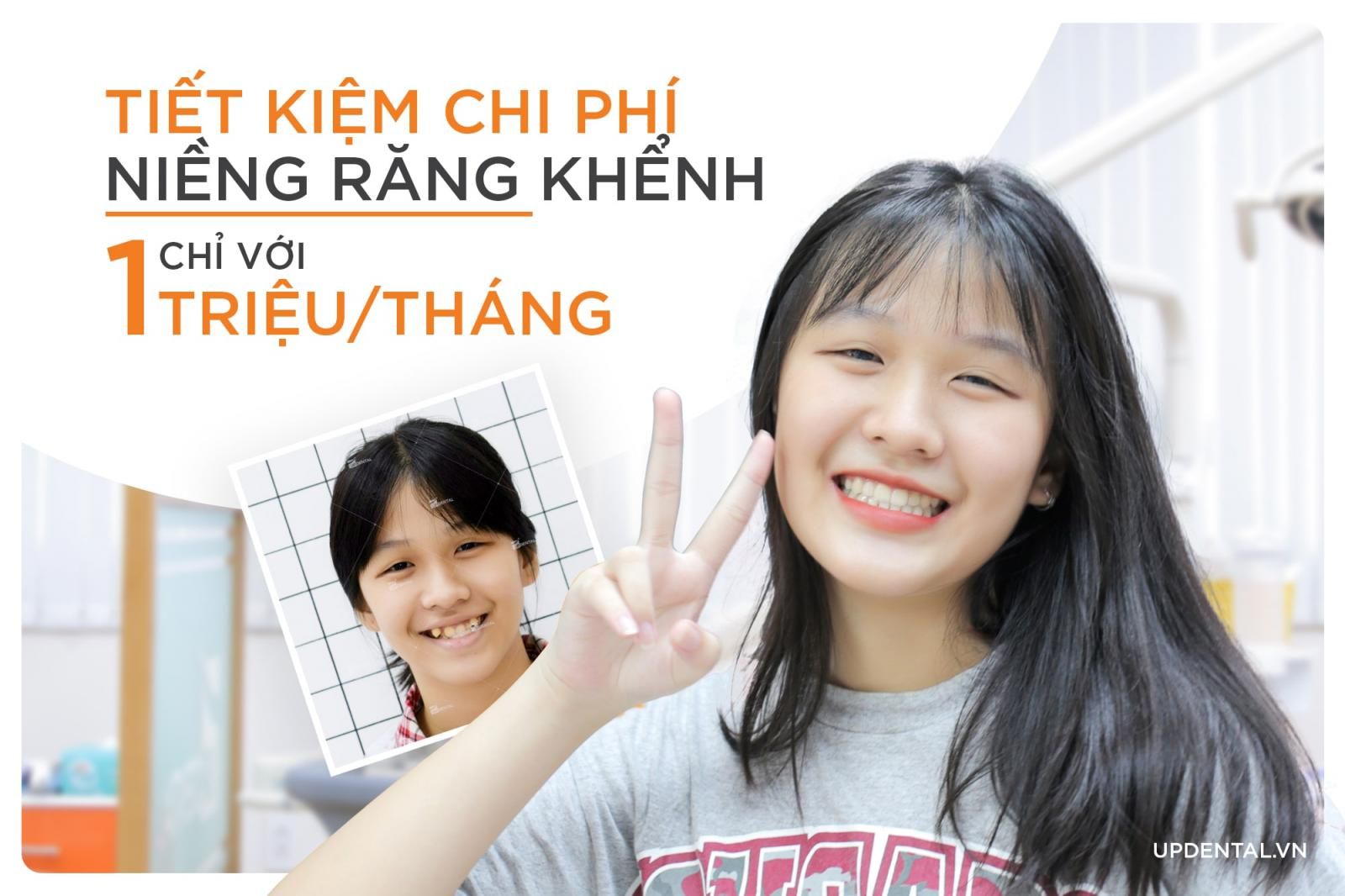 niềng răng khểnh chỉ với 1 triệu/tháng