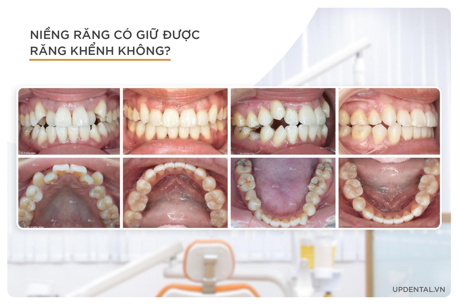 niềng răng có giữ được răng khểnh không