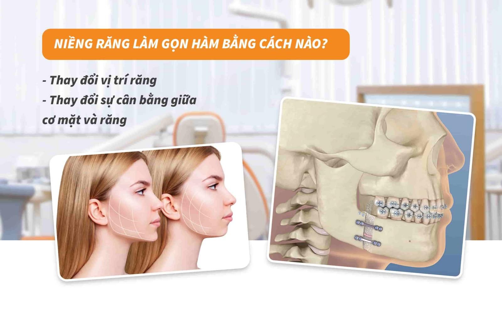  Niềng răng làm gọn hàm bằng cách nào