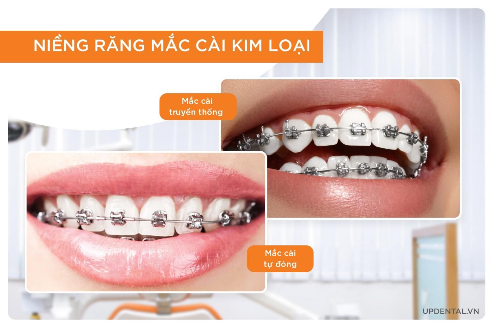 niềng răng mắc cài kim loại