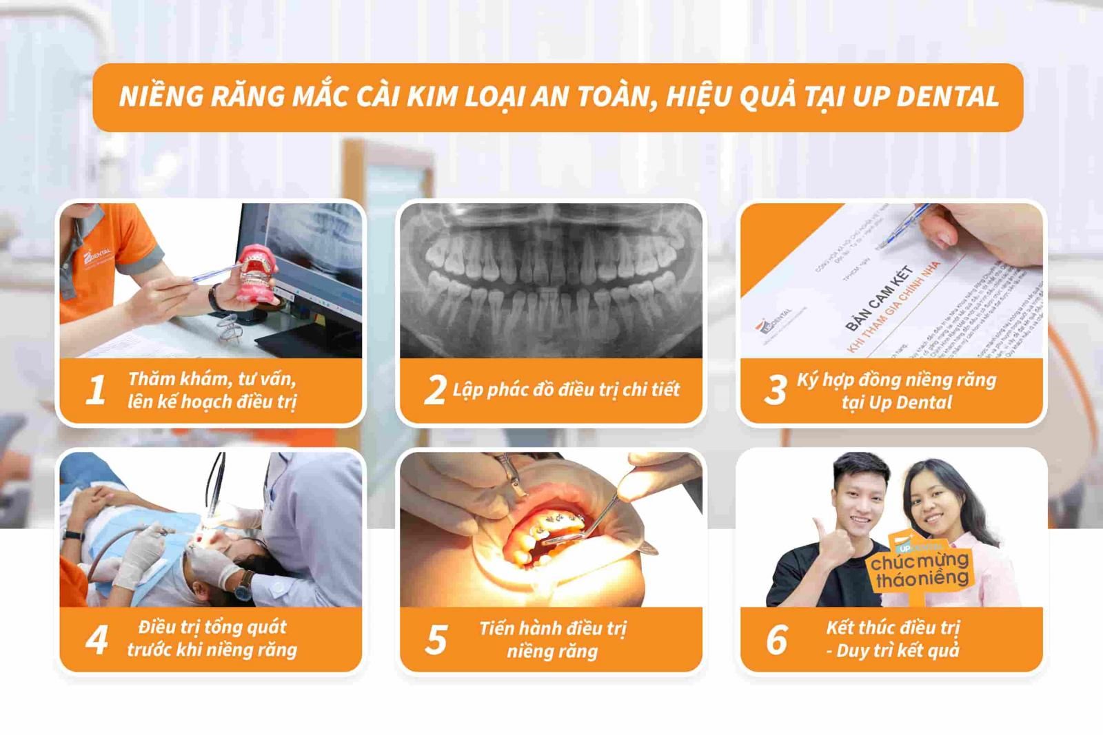 Niềng răng mắc cài kim loại an toàn, hiệu quả tại Up Dental