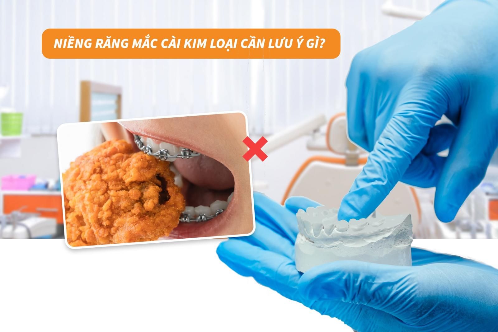 Niềng răng mắc cài kim loại cần lưu ý gì