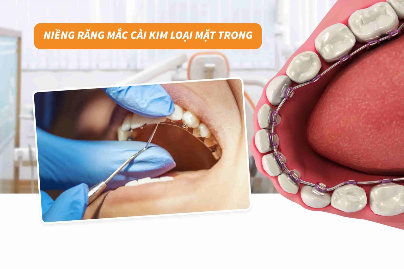 Niềng răng mắc cài kim loại mặt trong