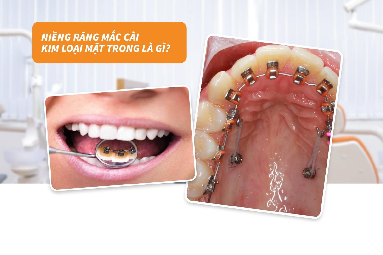 Niềng răng mắc cài kim loại mặt trong là gì?