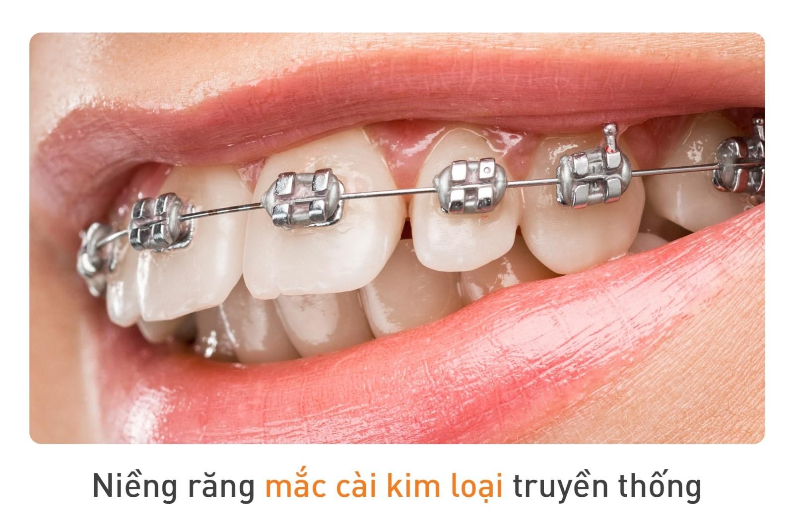 niềng răng mắc cài kim loại truyền thống