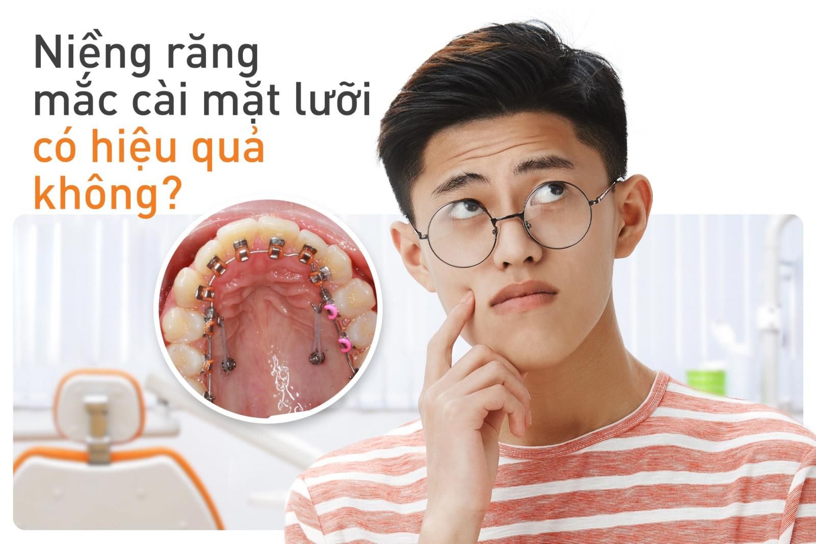 ưu điểm của phương pháp niềng răng mắc cài mặt lưỡi