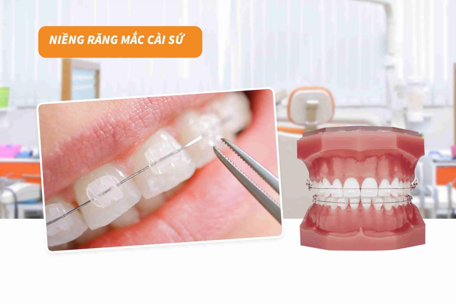 Niềng răng mắc cài sứ