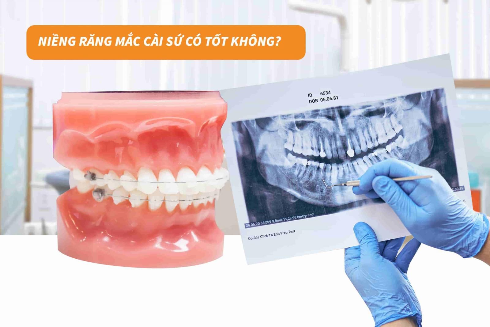 Niềng răng mắc cài sứ có tốt không?