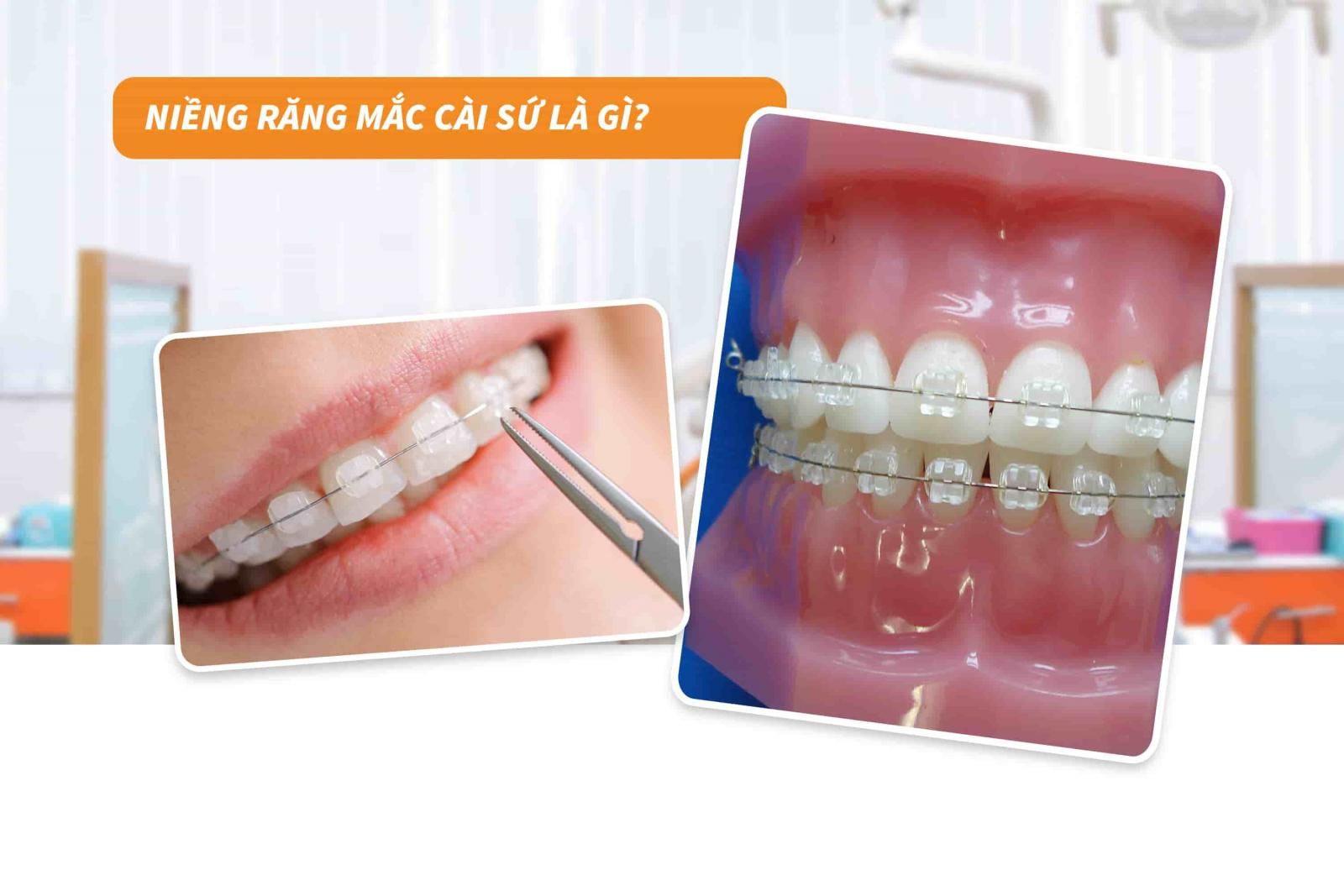 Niềng răng mắc cài sứ là gì