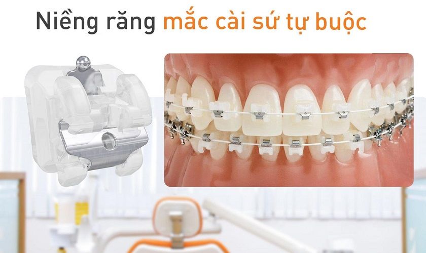 7. Thời gian điều trị niềng răng mắc cài sứ tự buộc