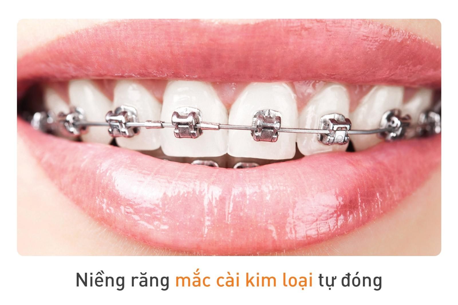 niềng răng mắc cài tự buộc