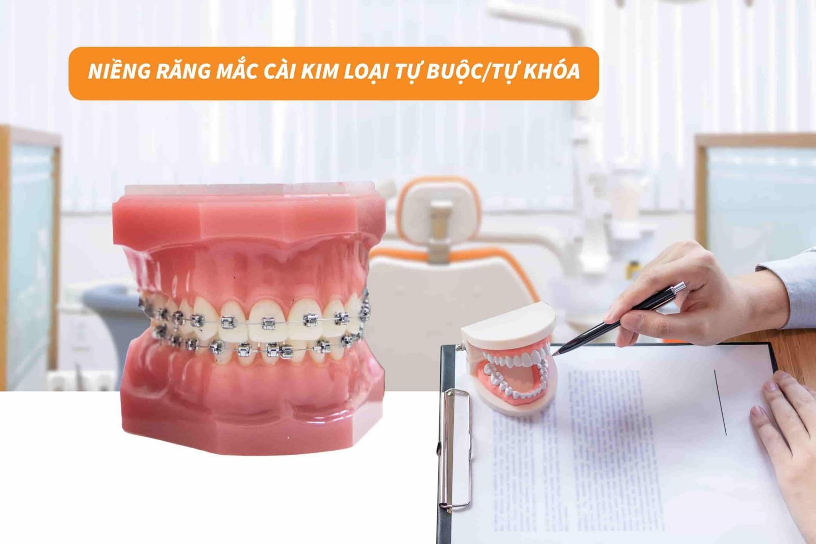 Niềng răng mắc cài kim loại tự khóa